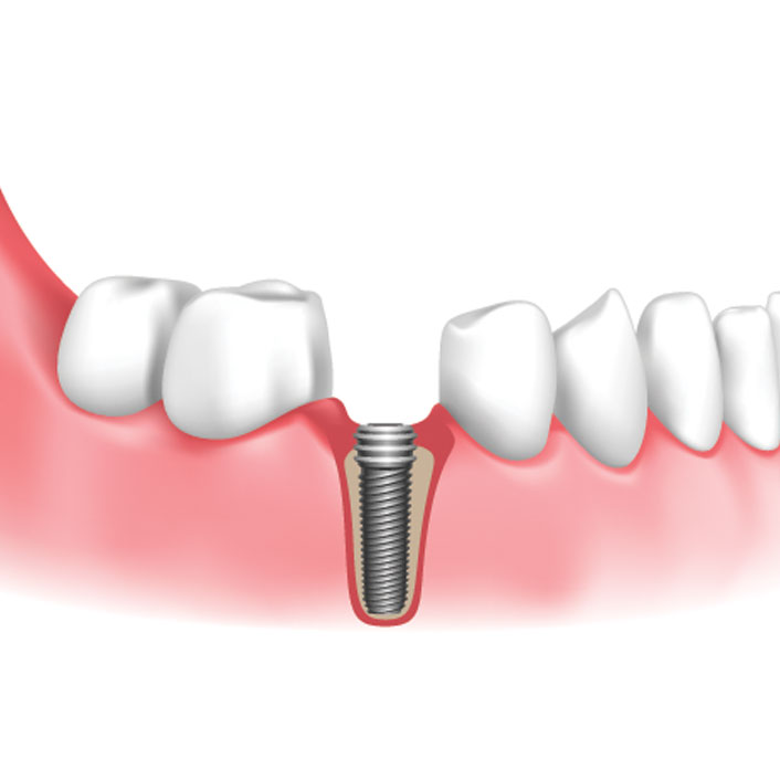Implant Placement - Dental Services