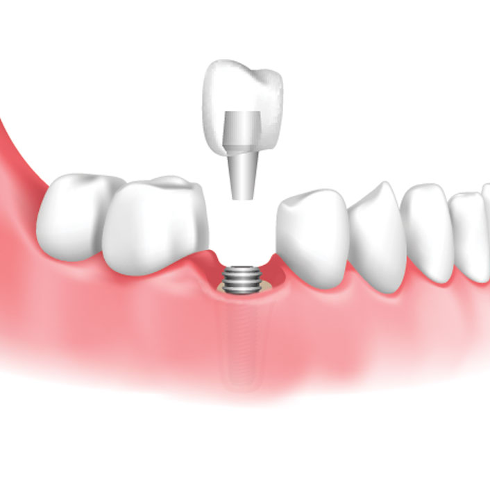 Implant Restoration - Dental Services