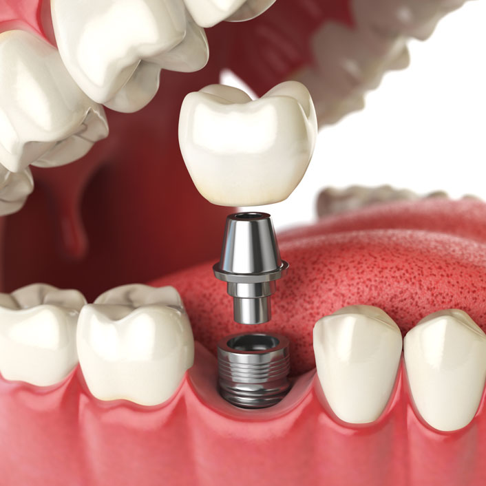 Dental Implants - Dental Services